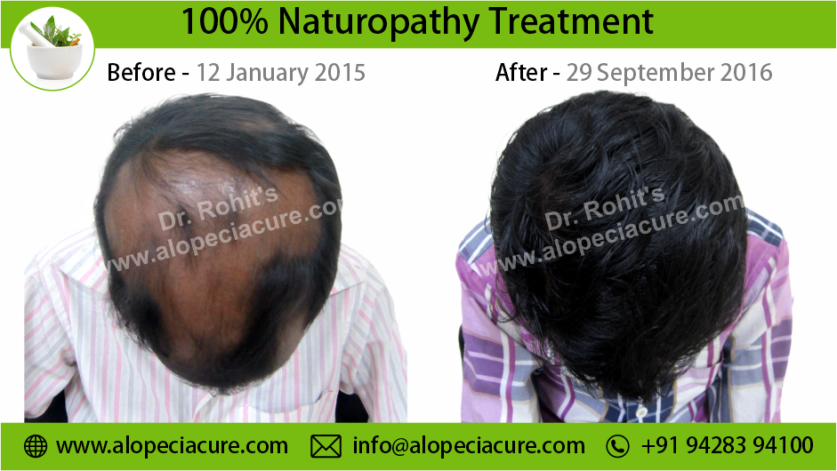 Alopecia Areata Result 6